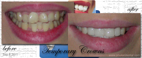 Temporary Crowns&Bridges at Phuket Dental Clinic,Thailand